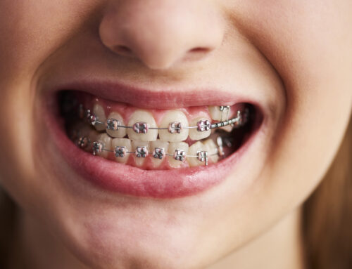 Pierwszy tydzień z aparatem ortodontycznym: Jak przetrwać ból i dyskomfort?