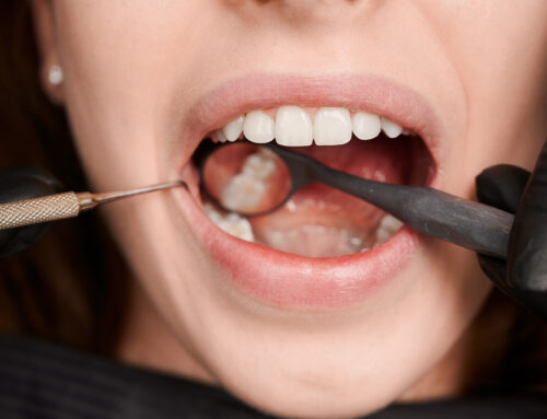 Próchnica czy przebarwienie? Jak rozpoznać, że Twój ząb potrzebuje leczenia